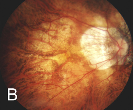 In eyes with pathologic myopia, MNV-related atrophy may develop and progress differently based on the atrophic pattern.