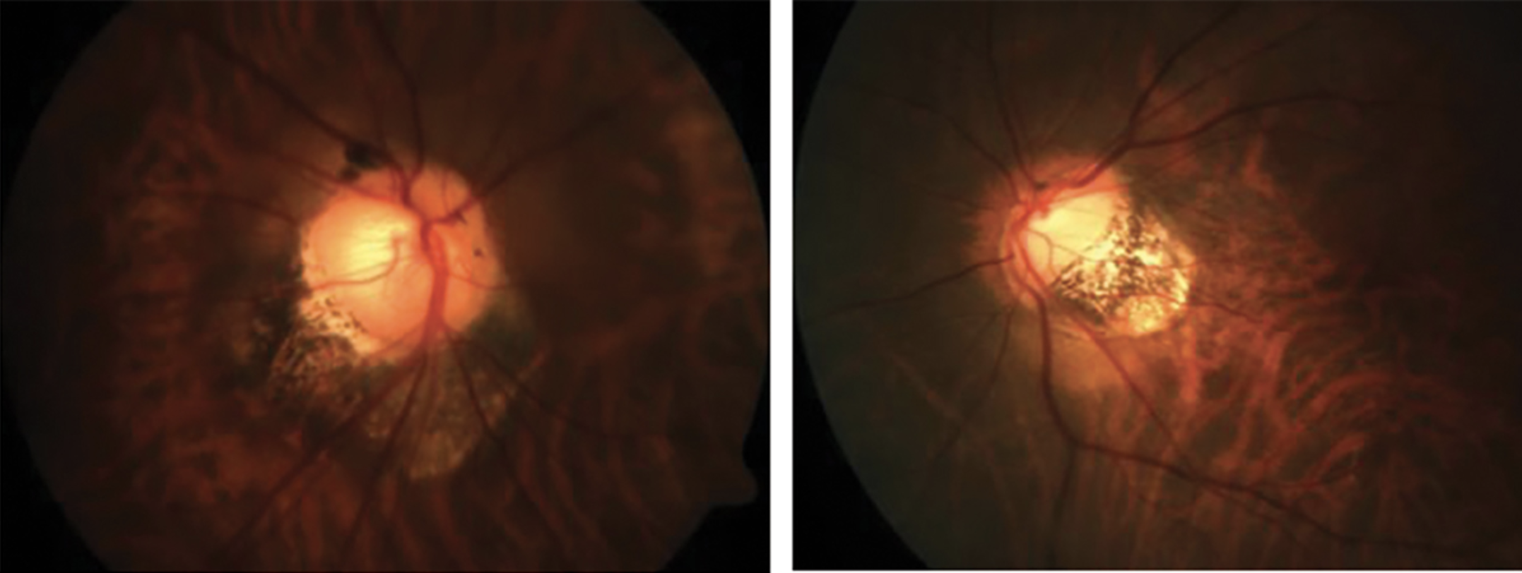 Myopic maculopathy was almost constant when posterior staphyloma (shown here) were present in this study, agreeing with prior data indicating eyes with this condition have worse visual prognosis.