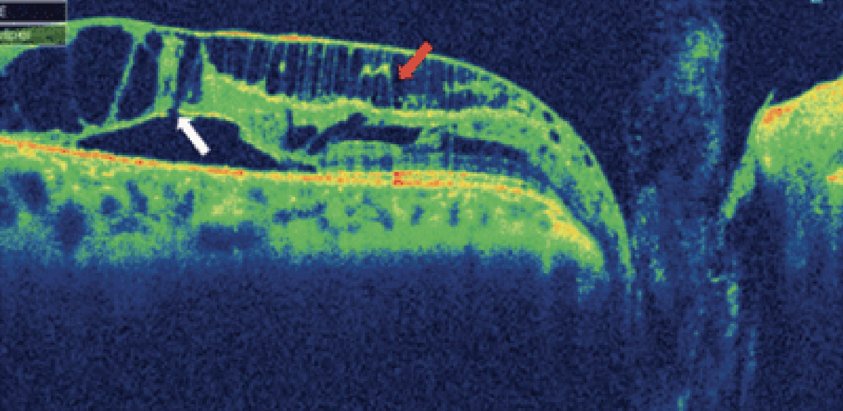 Multiple retinal splits can be seen in this patient with an optic pit is typical of a macula retinoschisis. 