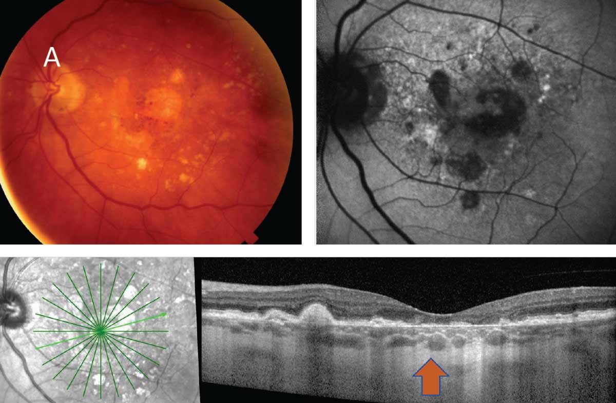 Fig. 5. The clinical images above and below depict the two types of late or advanced macular degeneration. (A) Late or advanced atrophic AMD in the presence of GA. (B) Late or advanced wet AMD.