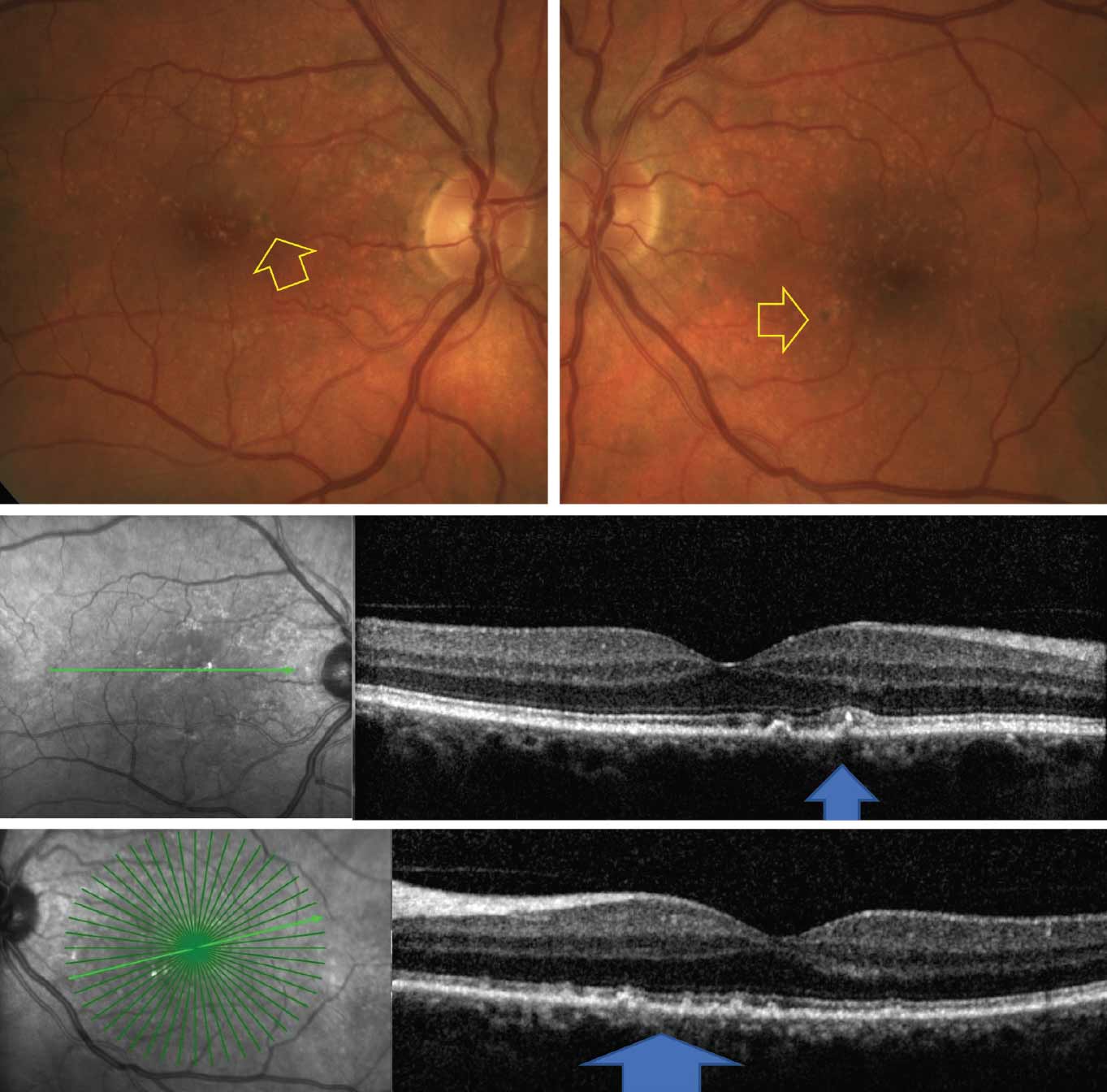 Fig. 6. Fundus photos (top) show multiple drusen and pigmentary abnormalities (yellow arrow). OCT (bottom) shows medium and large size drusen (blue arrows). 