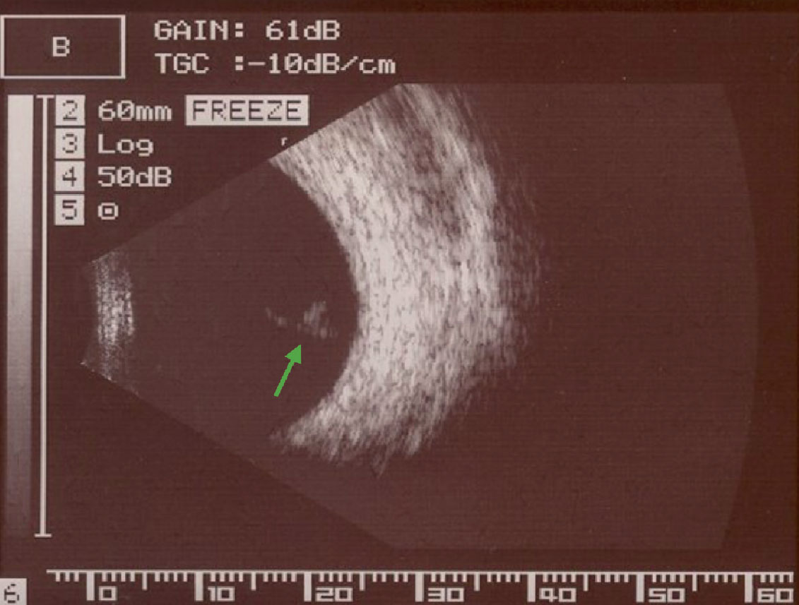 Fig. 1. B-scan ultrasonography imaging of a Weiss ring visible within the posterior vitreous after PVD.