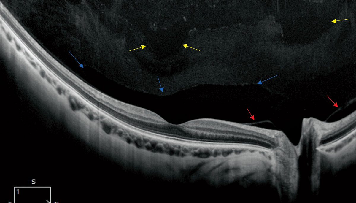 Fig. 2. A high-resolution single line scan OCT of a healthy, myopic 30-year-old (12mm HD 1-Line Raster 100x, Zeiss Cirrus OCT). The blue arrows point to the normal anatomic bursa premacularis. The red arrows reveal a non-pathologic release of the posterior hyaloid. In the more anterior aspect of the image, there is evidence of liquefaction noted by the optically empty voids noted by the yellow arrows.