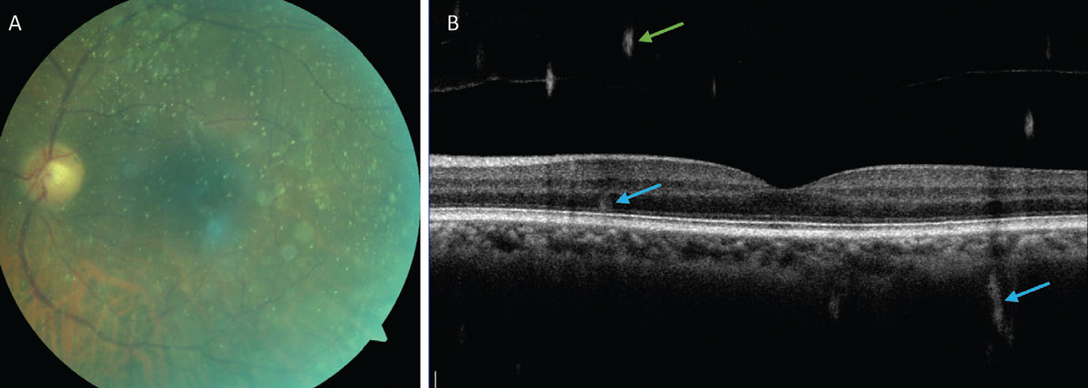 Fig. 7. (A) Fundus photo showing asteroid hyalosis and demonstrating the limited visibility of the retina. (B) An OCT B-scan of the retina with asteroid bodies visible in the vitreous (green arrows) and artifacts from the asteroid bodies within the retina and choroid (blue arrows).