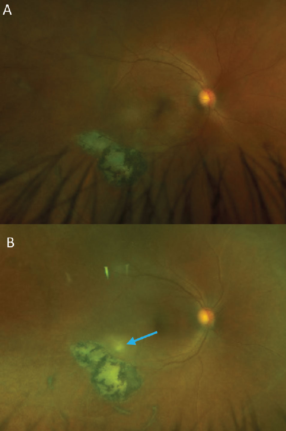 Fig. 8. (A) A patient with an inactive toxoplasmosis gondii chorioretinal scar. (B) The same patient with a reactivated infection. The new, white retinal lesion can be seen just superior to the existing scar. A mild vitritis is evident from the haziness of the photo compared to the original. Small cells can be seen on close inspection of the optos photo as well as within the vitreous on the OCT B-scan (green arrows, C). This patient was seen very soon after acutely noticing new floaters in their vision and the vitritis in this case is more subtle than is often seen with toxoplasmosis.