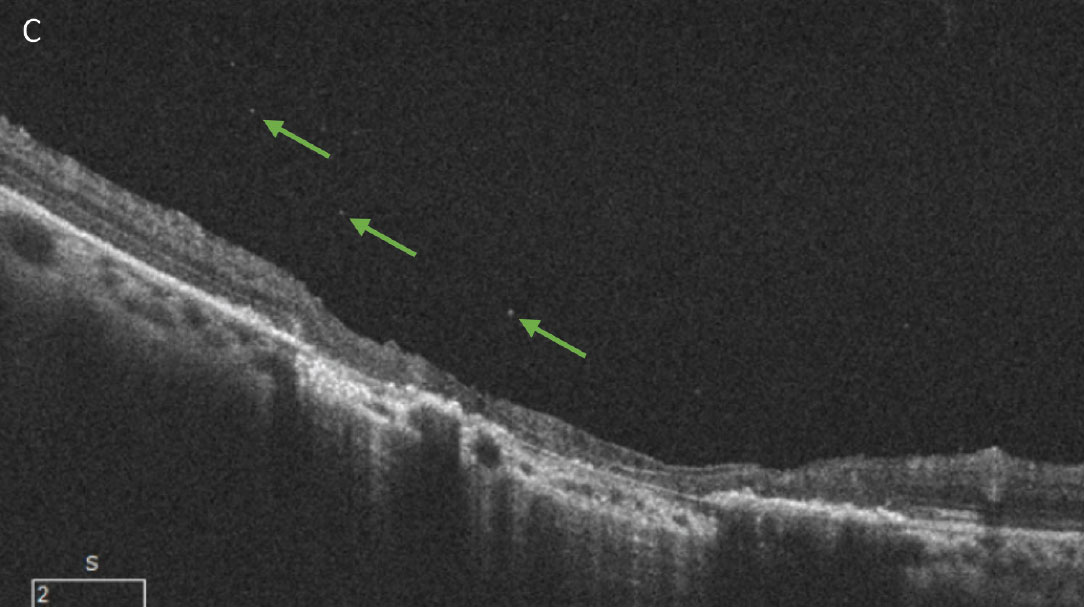 Fig. 8. (A) A patient with an inactive toxoplasmosis gondii chorioretinal scar. (B) The same patient with a reactivated infection. The new, white retinal lesion can be seen just superior to the existing scar. A mild vitritis is evident from the haziness of the photo compared to the original. Small cells can be seen on close inspection of the optos photo as well as within the vitreous on the OCT B-scan (green arrows, C). This patient was seen very soon after acutely noticing new floaters in their vision and the vitritis in this case is more subtle than is often seen with toxoplasmosis.