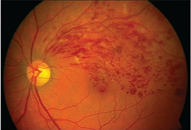 The study also found that visual acuity at the return visit is influenced by baseline acuity as well as central macular thickness at various visits throughout the treatment course.
