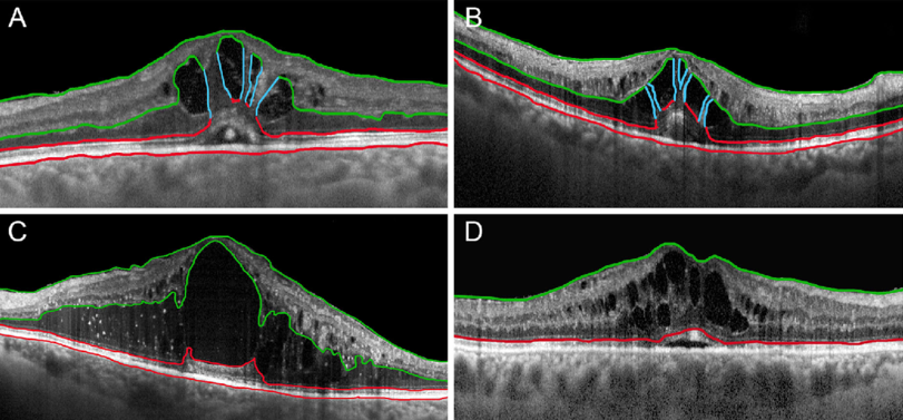 Foveal eversion (FE) patterns in retinal vein occlusion: (A) is characterized by the presence of thick intraretinal vertical columns; (B) shows thinner intraretinal vertical columns, whereas (C) has no sign of columns in the context of intraretinal macular edema. RVO eyes with macular edema, showing a sign of foveal depression, are classified as “no FE” eyes. (D) Retinal vein occlusion. From Arrigo, A., Aragona, E., Antropoli, A. et al. Foveal Eversion is Associated with High Persistence of Macular Edema and Visual Acuity Deterioration in Retinal Vein Occlusion.Ophthalmol Ther (2023).