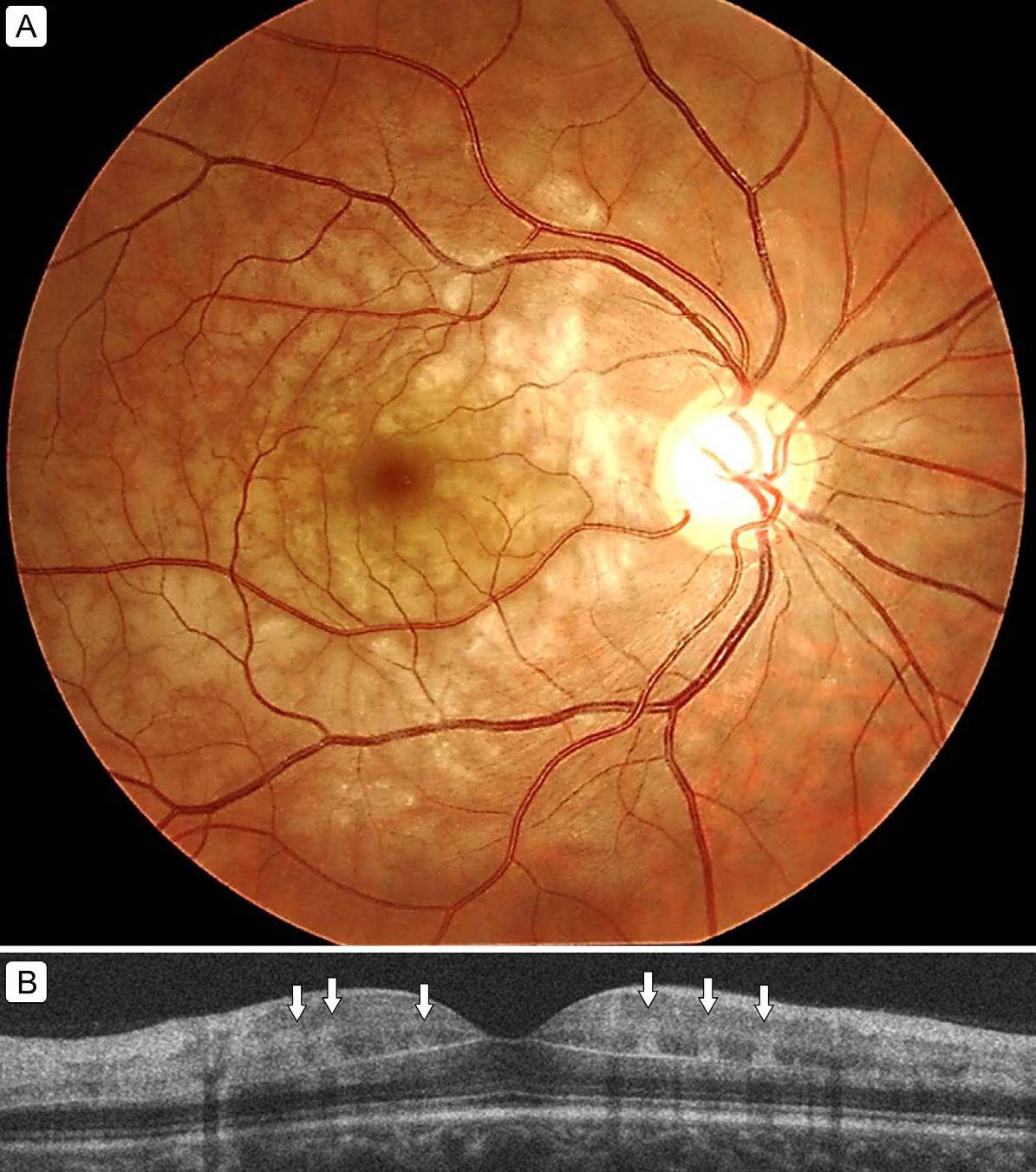 A complete stroke evaluation might be necessary in patients who present with PAMM to prevent a cerebrovascular event or progression to total blindness.
