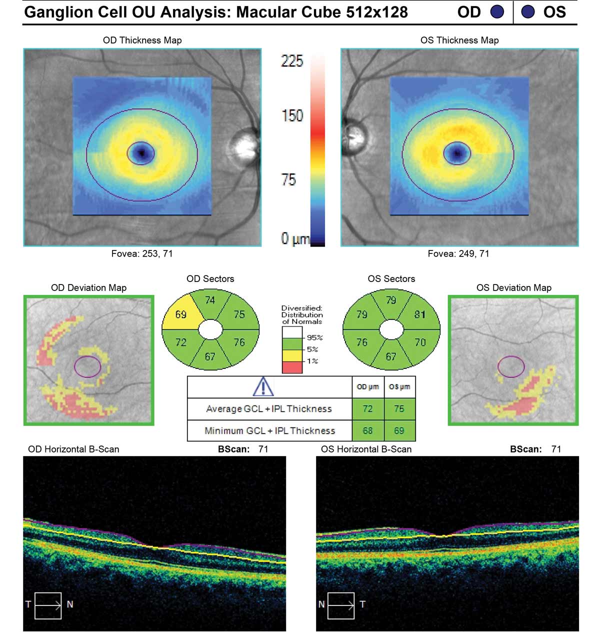 Unlike brain volume measured by MRI, GCL thickness (shown here in a glaucoma patient) is not directly affected by inflammation, representing a valuable measure of neurodegeneration especially relevant for MS prognosis.