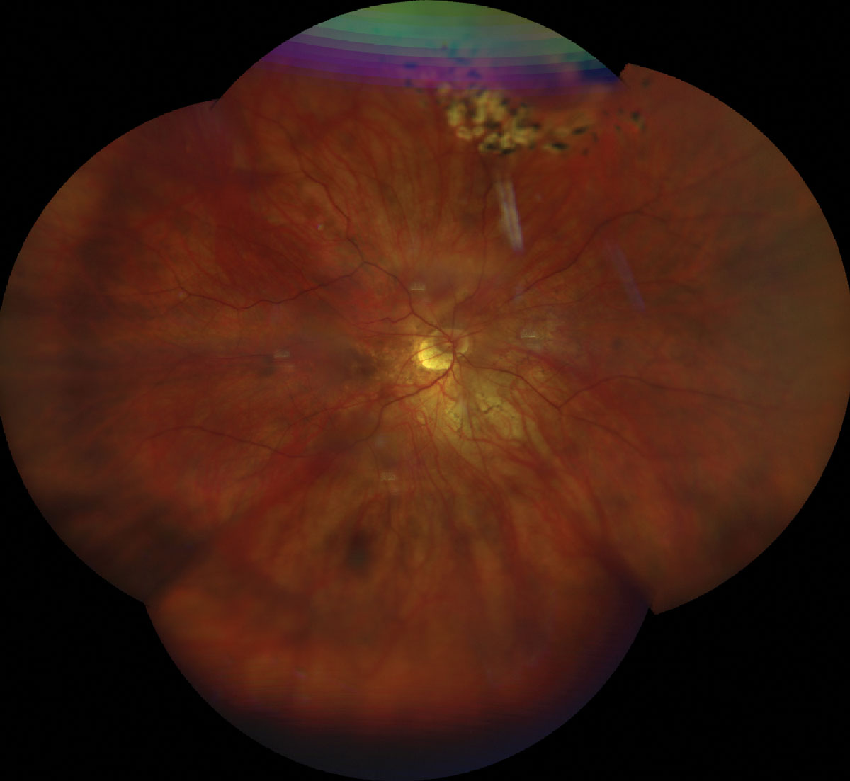 Fig. 1. UWF retinal photo of the top (A) and bottom (B) eye showing a tessellated fundus, tilted nerve with temporal crescent. Laser scars surrounding a laser tears superior OD/OS and lattice degeneration inferior OS.