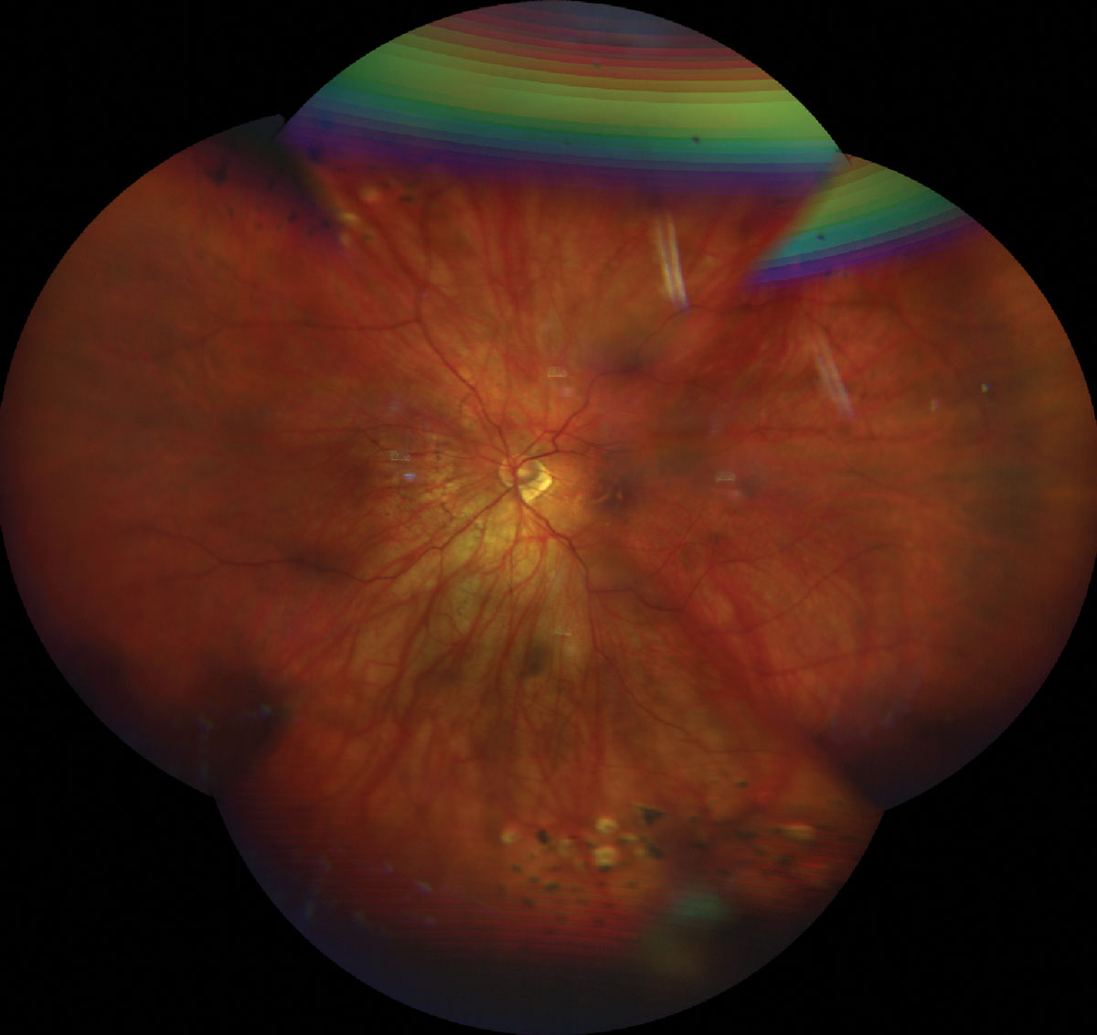 Fig. 1. UWF retinal photo of the top (A) and bottom (B) eye showing a tessellated fundus, tilted nerve with temporal crescent. Laser scars surrounding a laser tears superior OD/OS and lattice degeneration inferior OS.