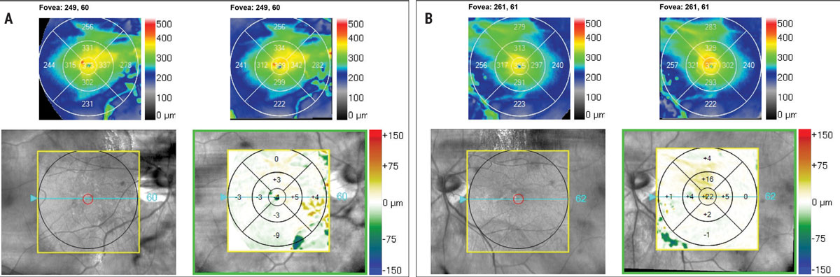 Fig 3. OCT change analysis of the macula taken 6 months apart. The right eye (A) is stable, the left eye (B) shows evidence of +22μm central subfield thickness.