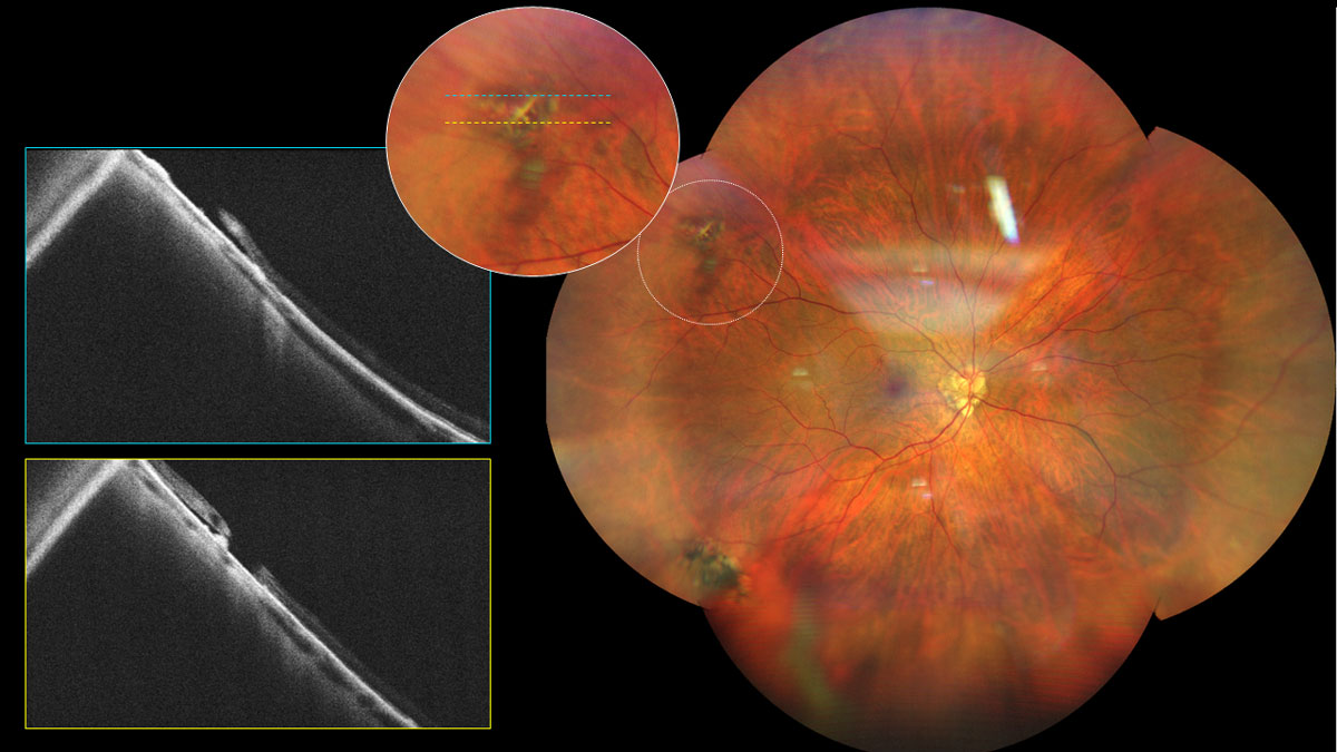 Fig 7. UWF and OCT imaging of a myopic patient with lattice degeneration and chronic RD.