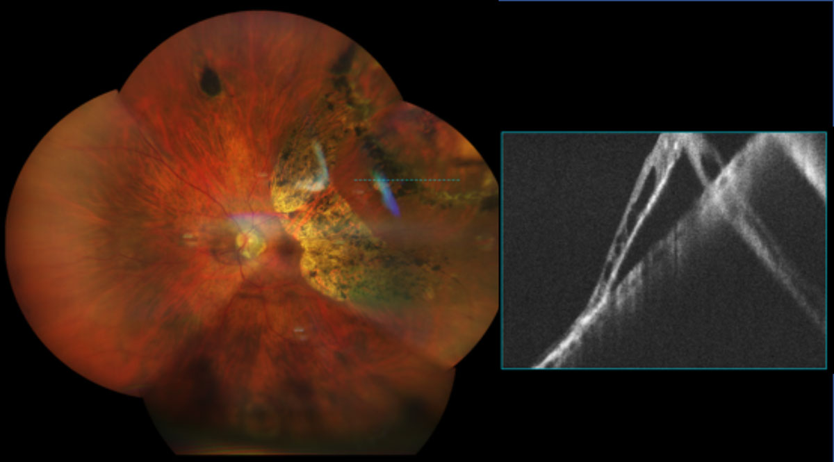 Fig 8. UWF and OCT imaging of a 65-year-old female -9.50D myope with lattice degeneration and chronic RD s/p barrier laser retinopexy.