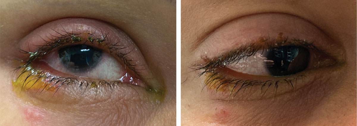 The patient’s initial presentation is shown at left and her appearance after resolution at right. What do you see here?