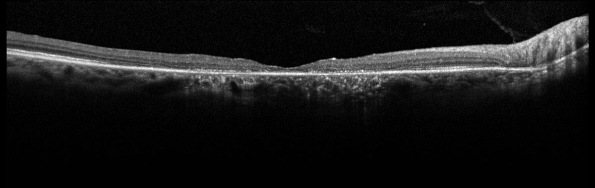Fig. 1. Heidelberg SD-OCT of the right macula.
