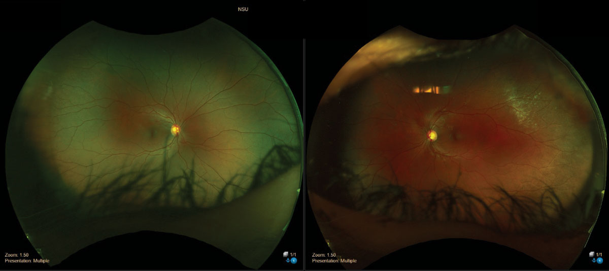 Commotio retinae superior temporal of the left eye.