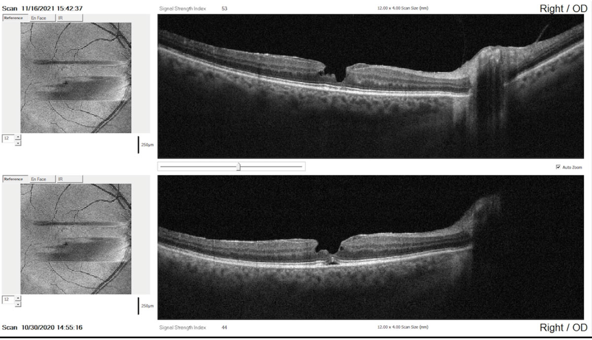 SD-OCT comparison report taken one year apart showing minor evidence of change in the contour and irregularity of the pseudohole (top: recent scan; bottom: baseline scan).