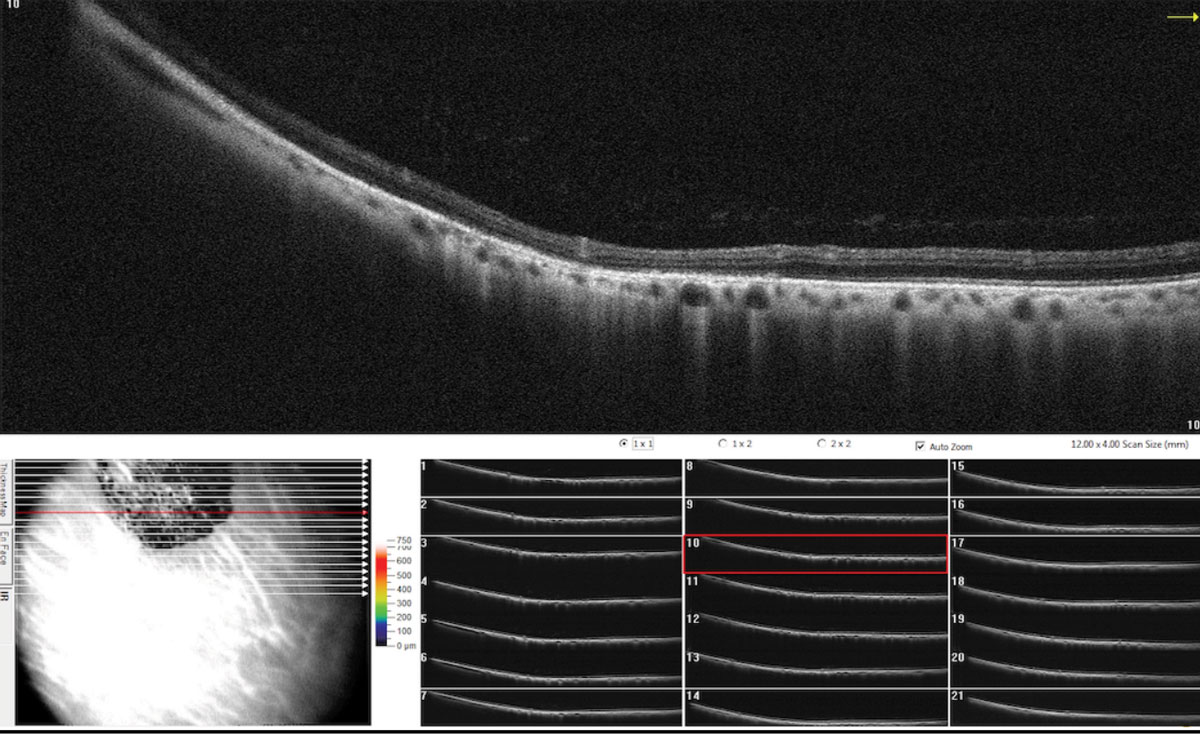 SD-OCT raster scan through the CHRPE illustrating retinal thinning above the lesions with photoreceptor loss and shadowing of underlying choroid.