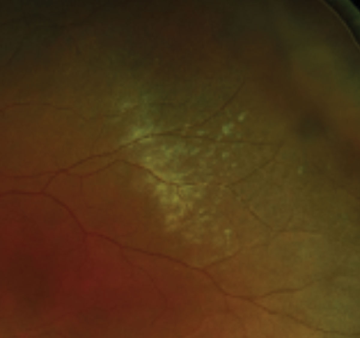 Magnified view of commotio retinae highlighting a confluent area of retinal whitening in the mid-periphery.