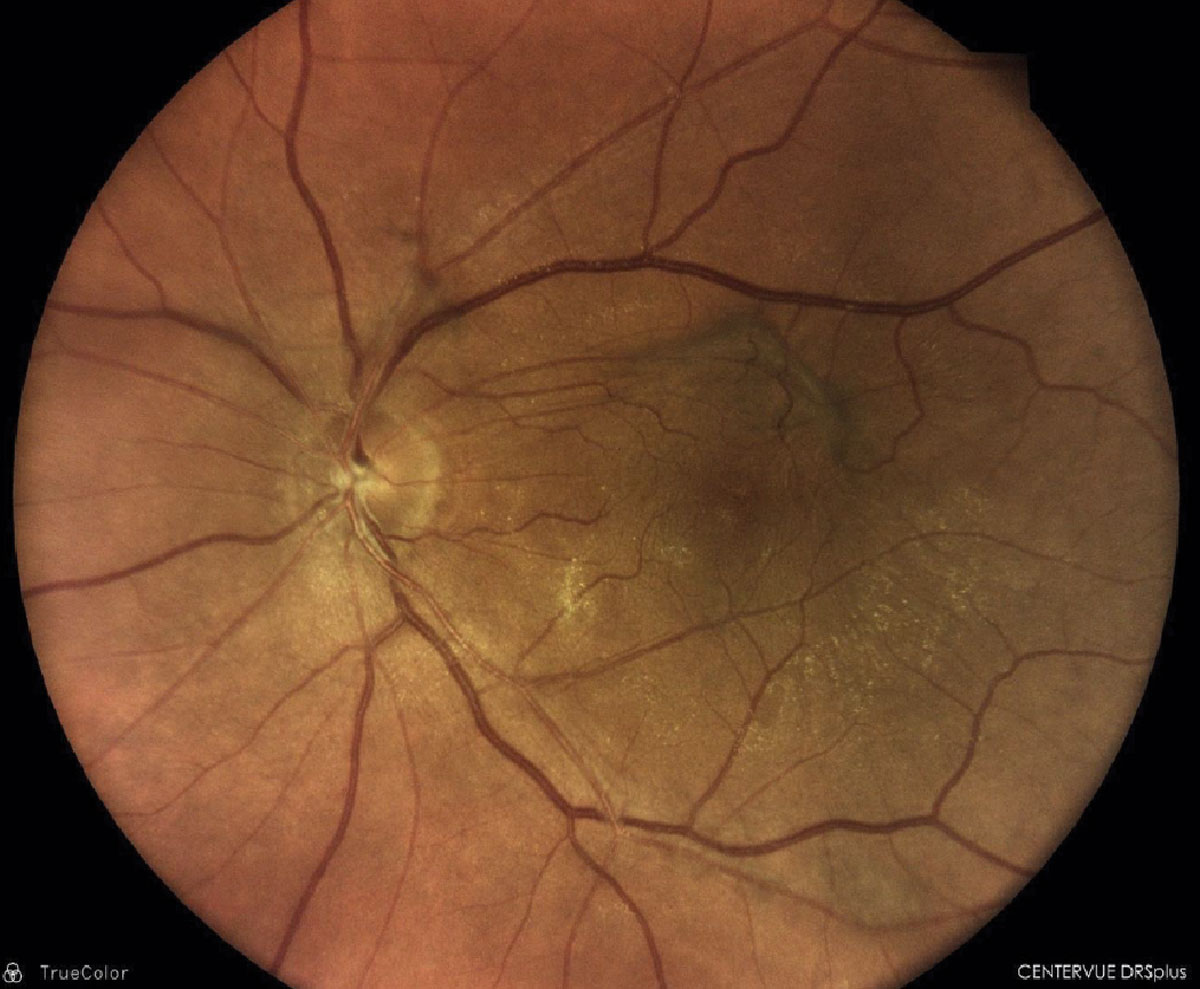 Epiretinal membrane with overlying vitreomacular traction membrane OS.