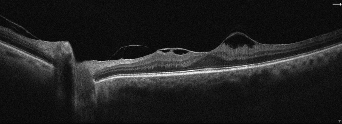 SD-OCT image highlighting vitreomacular traction with epiretinal membrane OS.