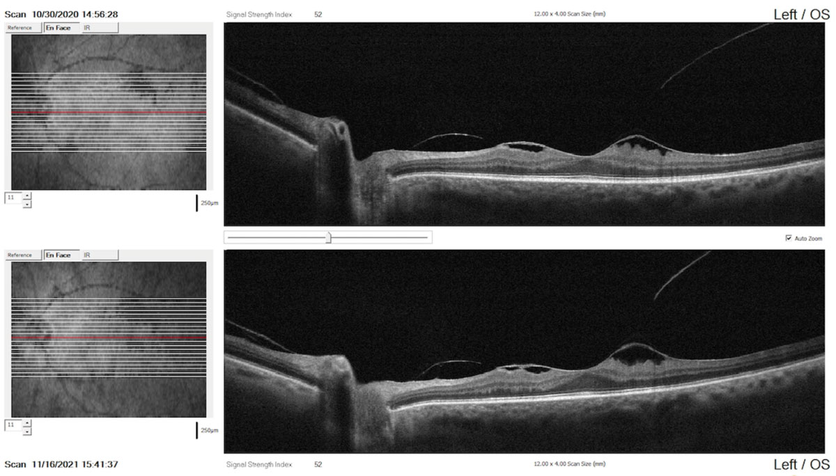 Comparison report with raster scans performed one year apart indicating the stability of the condition (top: baseline scan; bottom: recent scan).