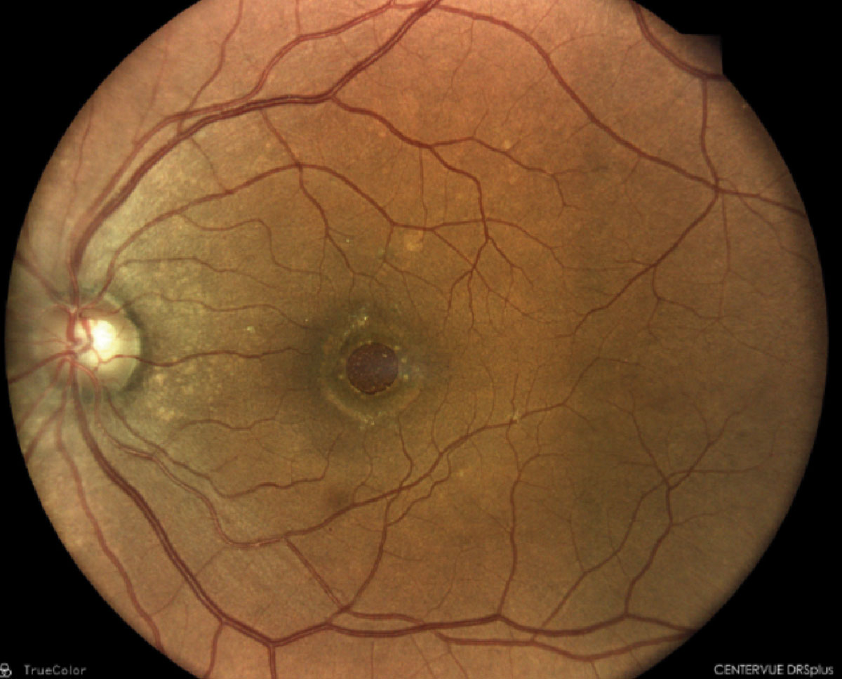 Full-thickness macular hole with surrounding fluid cuff.