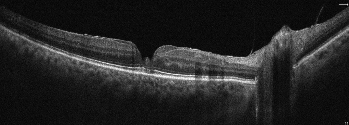 SD-OCT highlighting a partial thickness macular pseudohole with overlying epiretinal membrane.