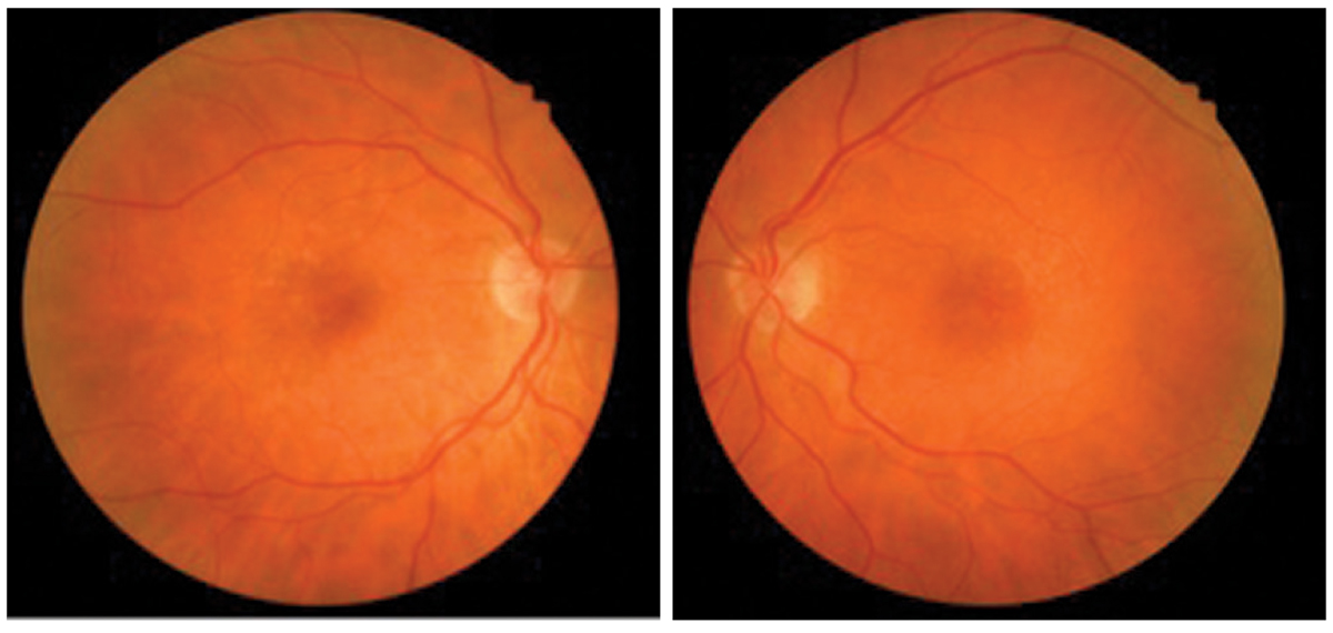 This patient was diagnosed with early dry AMD in both eyes. 