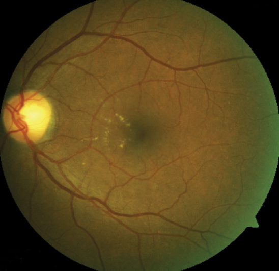 This fundus image shows clinically significant macular edema with  best-corrected visual acuity of 20/20. 