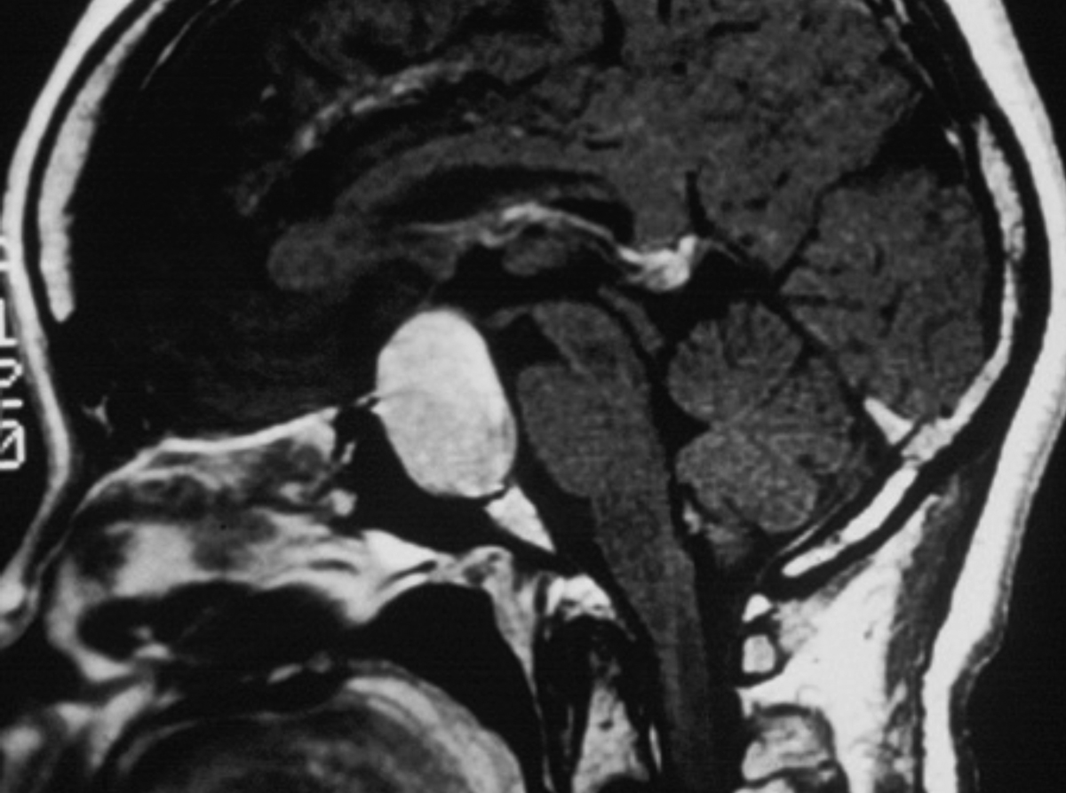 Fig. 2. Mid-sagittal MRI from a different patient that demonstrates a pituitary adenoma. This current patient underwent successful surgery, and the fields returned to normal.
