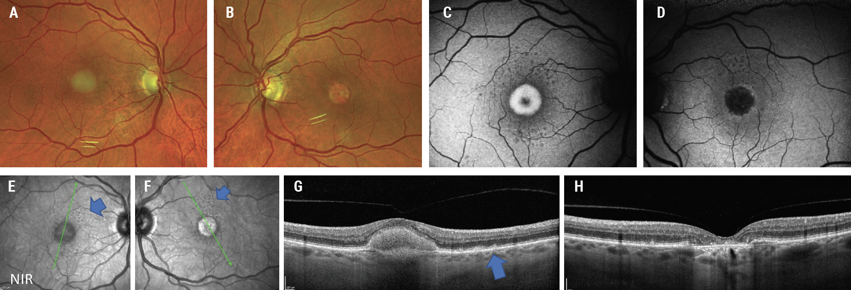 Fig. 1. Fundus photos show a classic foveal vitelliform lesion OD (A) and an atrophic foveal lesion OS (B). FAF of the right eye (C) shows hyperautofluorescence associated with increased lipofuscin, and the left eye (D) shows hypoautofluorescence associated with loss of RPE. The near-infrared reflectance en face images (E, F) show drusen and central lesions (blue arrows). OCT of the right eye (G) shows the central hyperreflective PED lesion and few drusen (blue arrow), and the left eye OCT (H) shows the central RPE and outer retinal atrophy. 