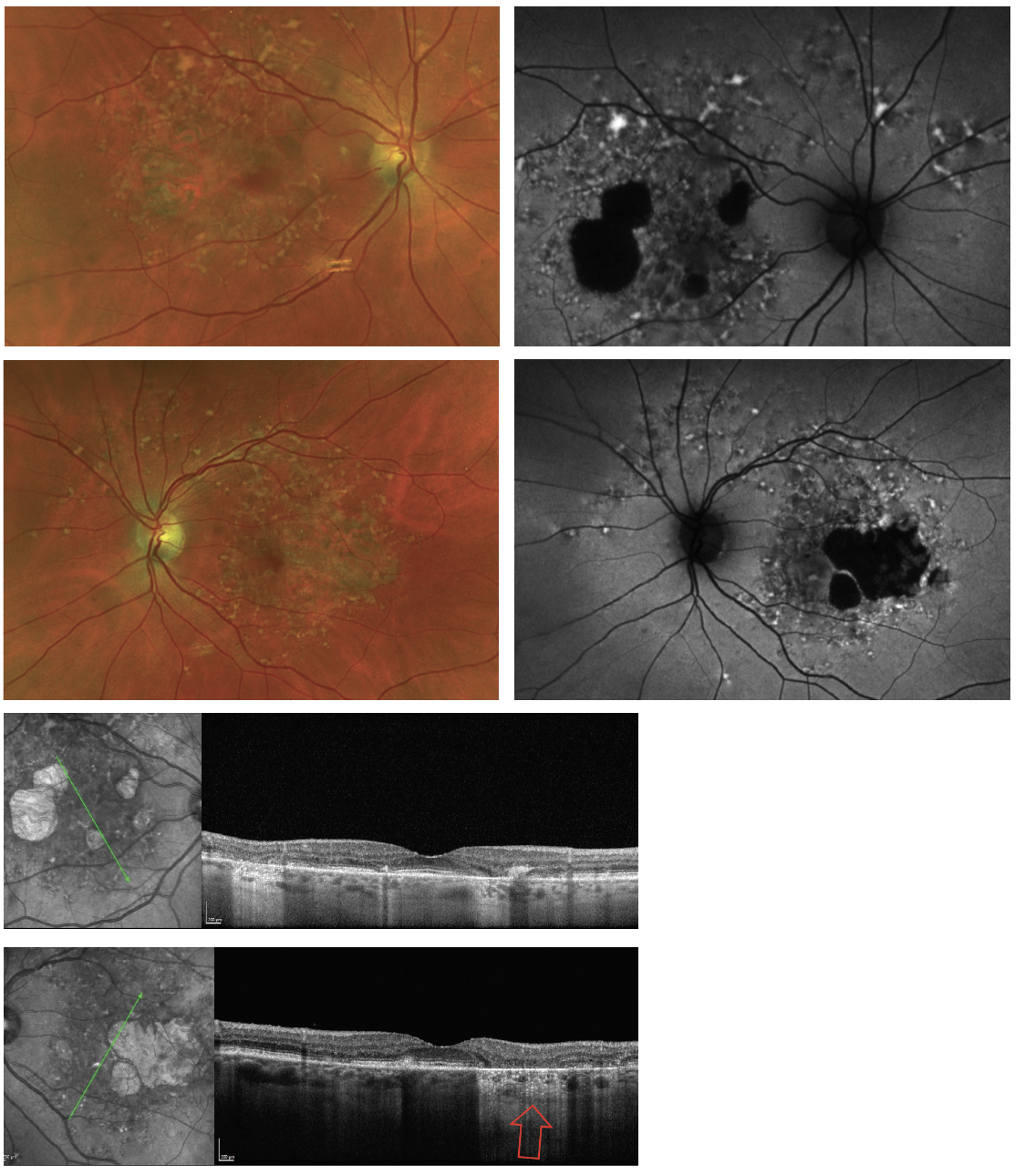Fig. 2. The yellowish-flecked lesions shown above are pisiform and pisciform lesions. They can be visualized on fundus photos and more notably on FAF as hyperautofluorescent lesions due to accumulation and increased lipofuscin. They can also be seen as atrophic lesions noted as hypoautoflurescence on FAF and by increased hypertransmission on OCT (red arrow). These are all signs of advanced Stargardt’s disease.  