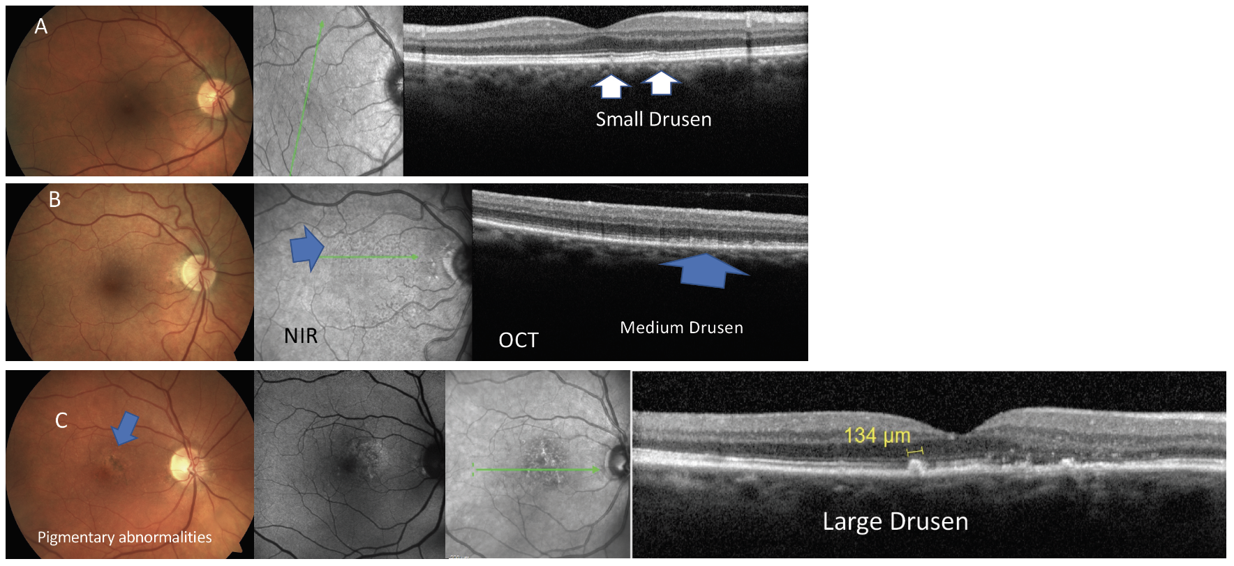 Fig. 4. Examples of the stages of dry or atrophic macular degeneration shown by common imaging modalities.
