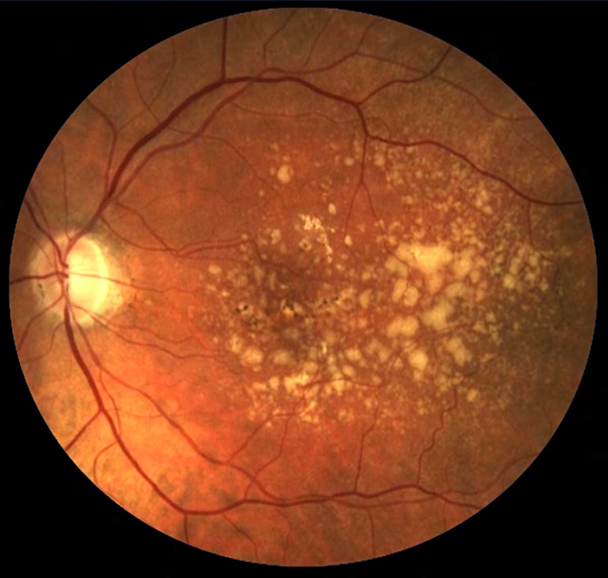 In cases of concurrent amblyopia and AMD, research shows that the amblyopic eye is typically less affected by AMD, though the mechanism behind this observation is unclear. 