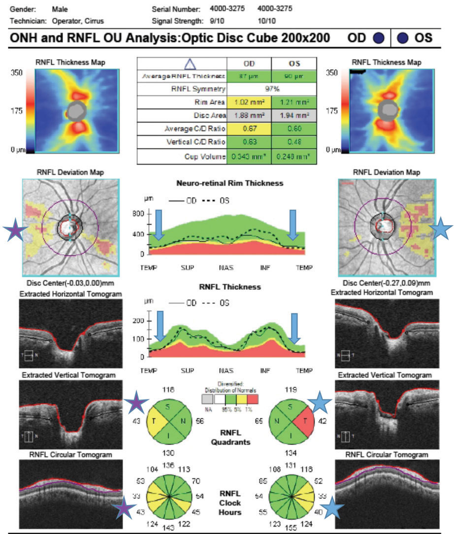 A decrease of macular RNFL thickness appeared more often in this study in patients with both glaucoma and high myopia than in high myopes alone, arguing for its diagnostic value.