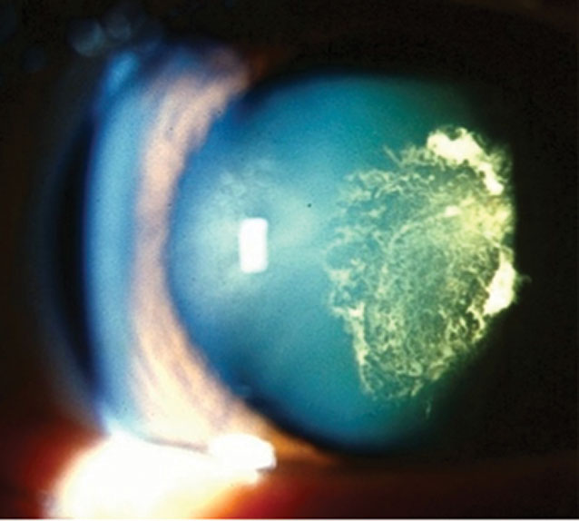 The impaired detection of perfusion deficits within the central macula of cataract eyes needs to be appreciated when imaging the choriocapillaris in phakic eyes. 