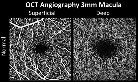 OCT-A may be more reliable for measuring larger caliber vessels, as indicated in greater variability seen with the macula than with the optic nerve head.