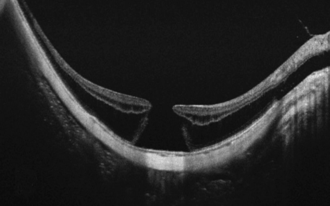 Posterior sclera reinforcement is recommended for grades 1 and 2 MTM, while in grade 3 and pre-advanced stage MTM, performing posterior sclera reinforcement is advised, with vitreoretinal surgery or macular buckling suggested if the patient loses two or more lines of BCVA in three months. 