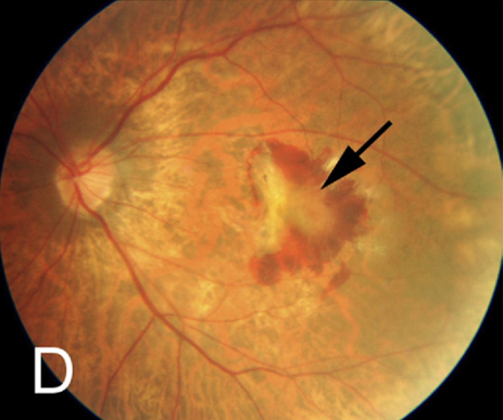 Impaired VEGF upregulation may explain why older patients had a lower risk of second-eye myopic macular neovascularization (MNV) onset than patients under 40.