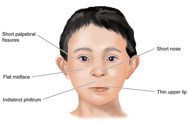 Several small studies have suggested children with FASD may be at an increased risk of various refractive and ocular conditions. A more recent, large study identified strabismus as a potential visual outcome of the disorder, but only in those with partial fetal alcohol syndrome.
