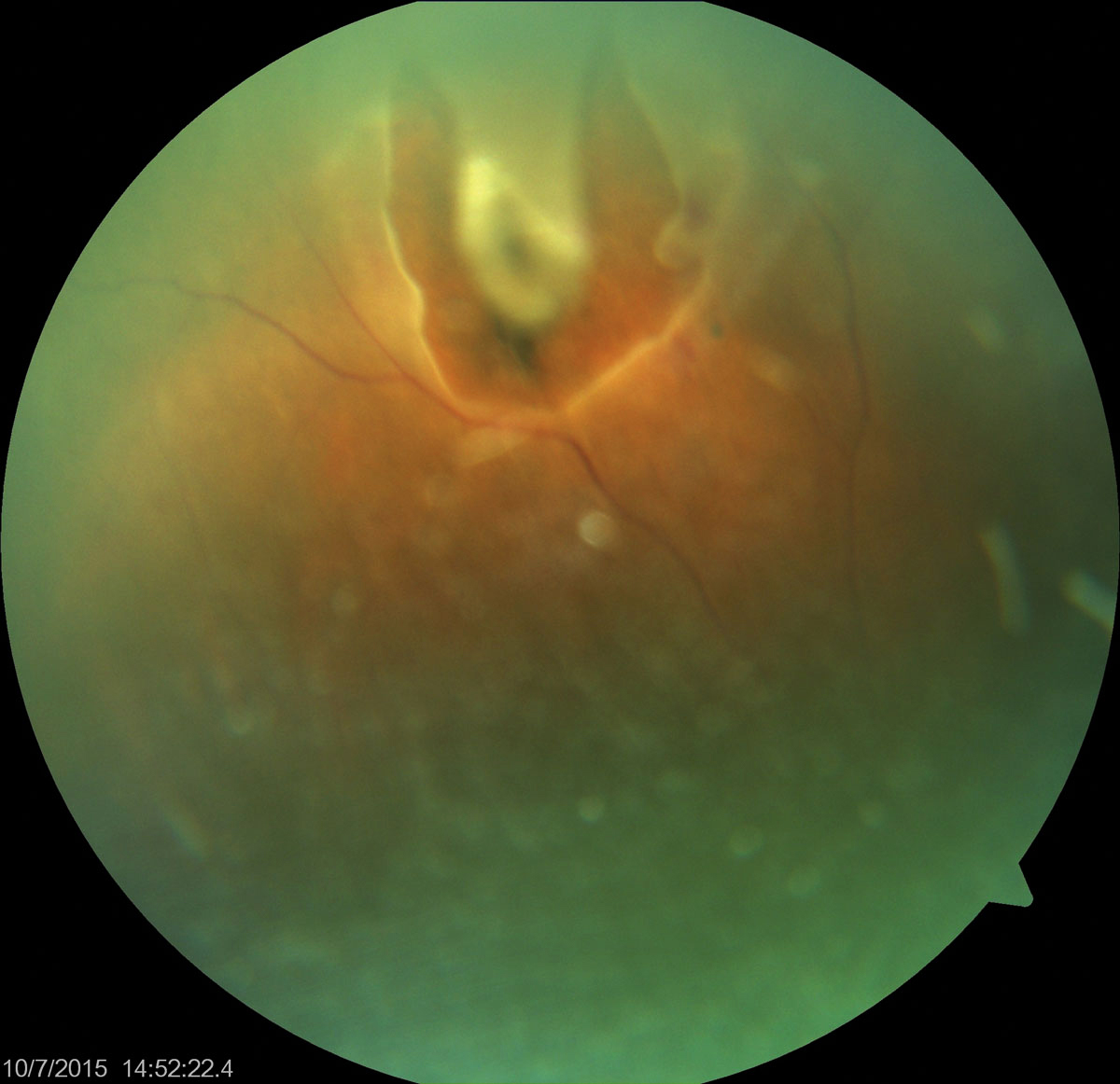 Similar studies reported ultra-widefield imaging sensitivities for retinal detachments and peripheral retinal lesions ranging from 41% to 86%.