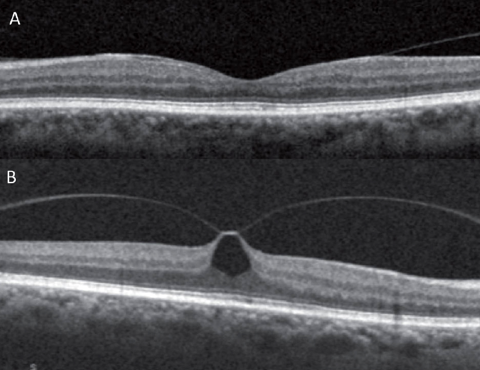 The researchers suggested that future studies can be conducted prospectively to analyze the progression of VMA (fig. A) as a means of anticipating vitreomacular traction (fig. B) and subsequent macular hole development.
