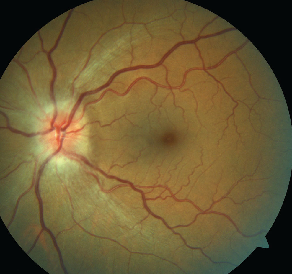 Researchers suggest that the volume of fluid generated acutely by ischemic processes at the optic nerve head may be a key determinant of the appearance of subretinal fluid.