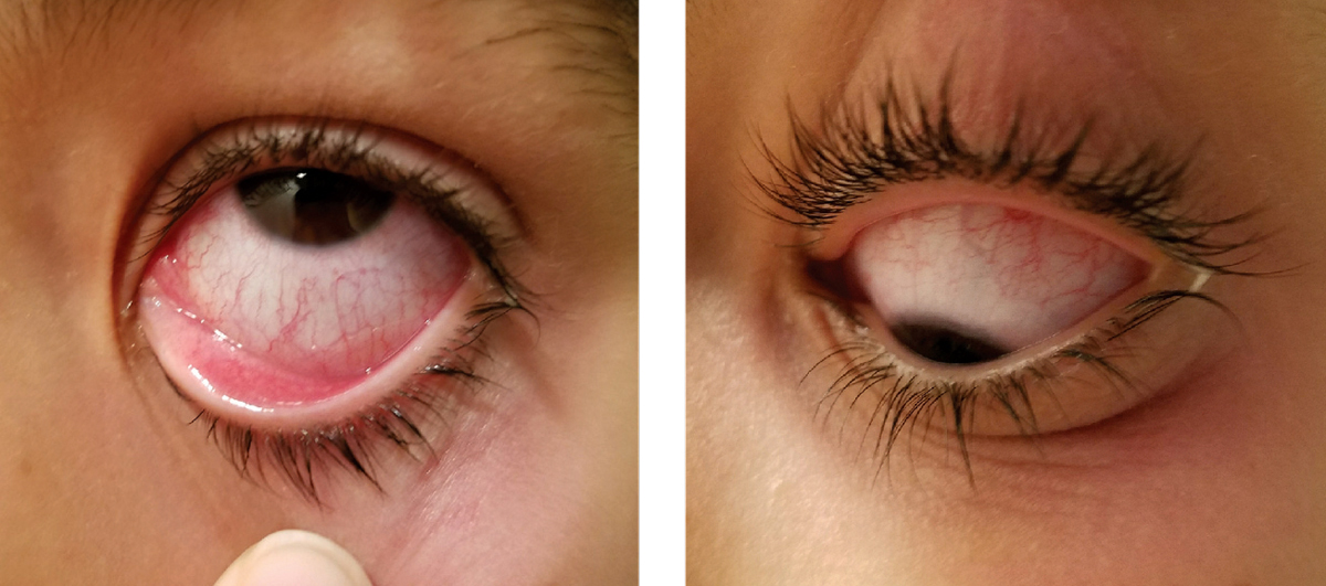 Many schools require students with “pink eye” to be prescribed an antibiotic before returning and that alone may argue for the intervention. However, a literature review found only marginal clinical benefit from it.