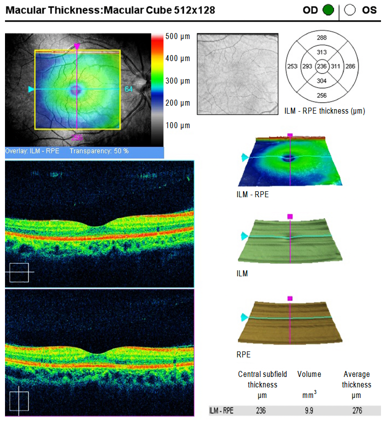 Retina specialists exhibited the highest level of agreement when grading macular thickness maps of patients with exudative AMD compared with foveal-centered B-scans or five macular B-scans including the central B-scan. (OCT image is from an unaffected patient.)