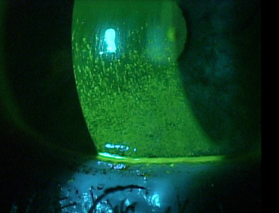 Fluorescein and nasal lissamine green staining each demonstrate distinctive patterns in Sjögren’s patients that can be of value clinically.