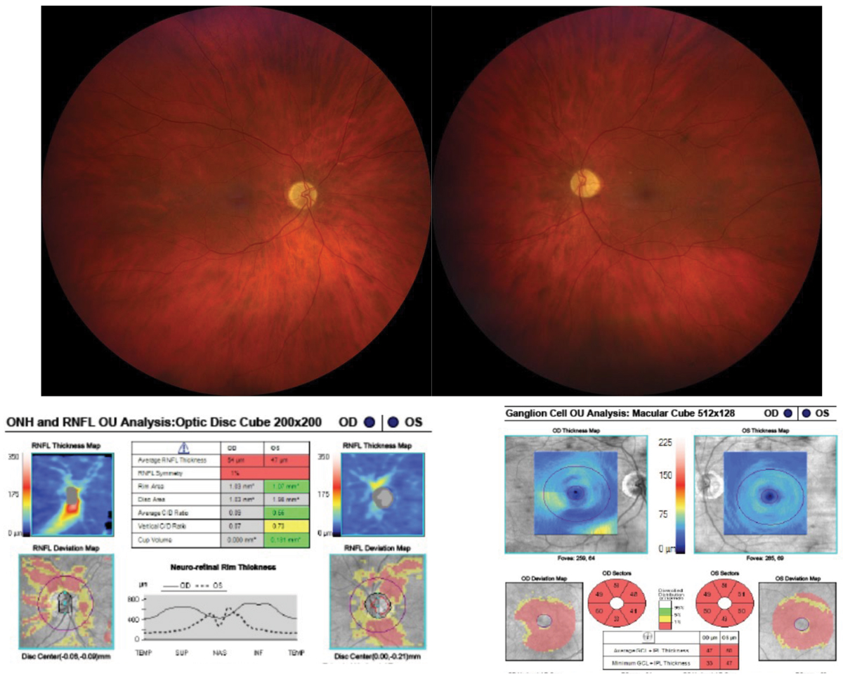 Although relative afferent pupillary defect (RAPD) presence is more commonly associated with asymmetric optic neuropathy, maculopathies can result in RAPD if associated with extensive asymmetric retinal damage. 